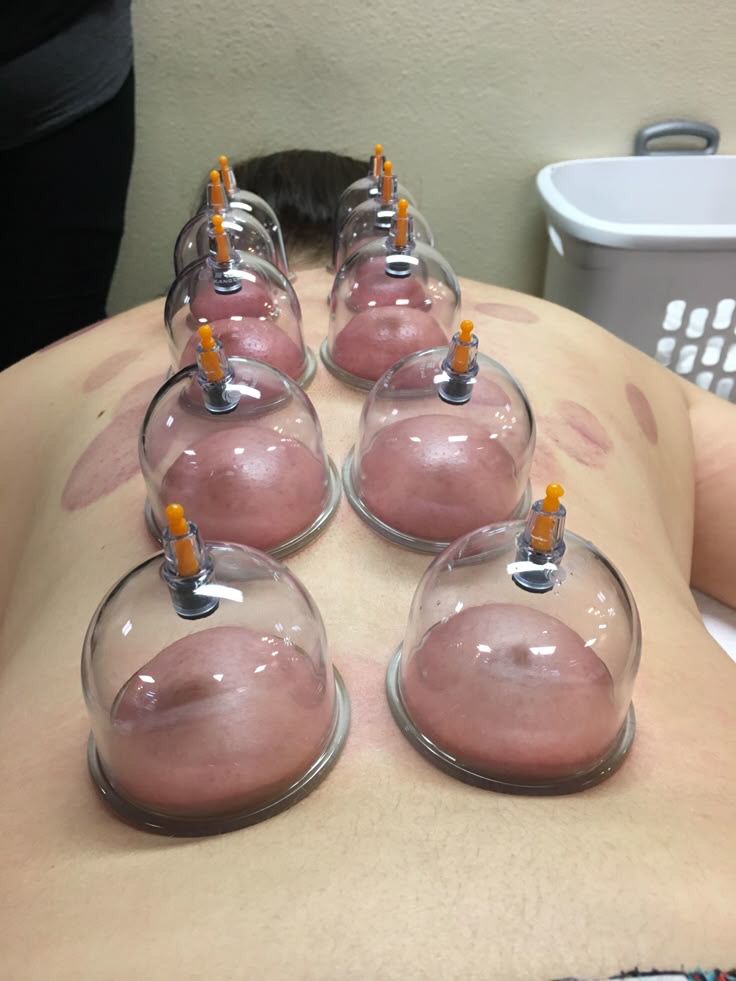 Cupping Therapy